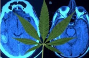 cannabis leaf and brain image